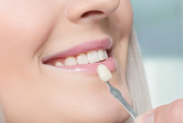 Veneers