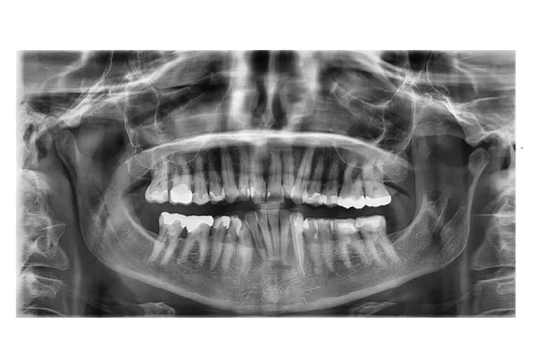 Dental  X-Ray OPG